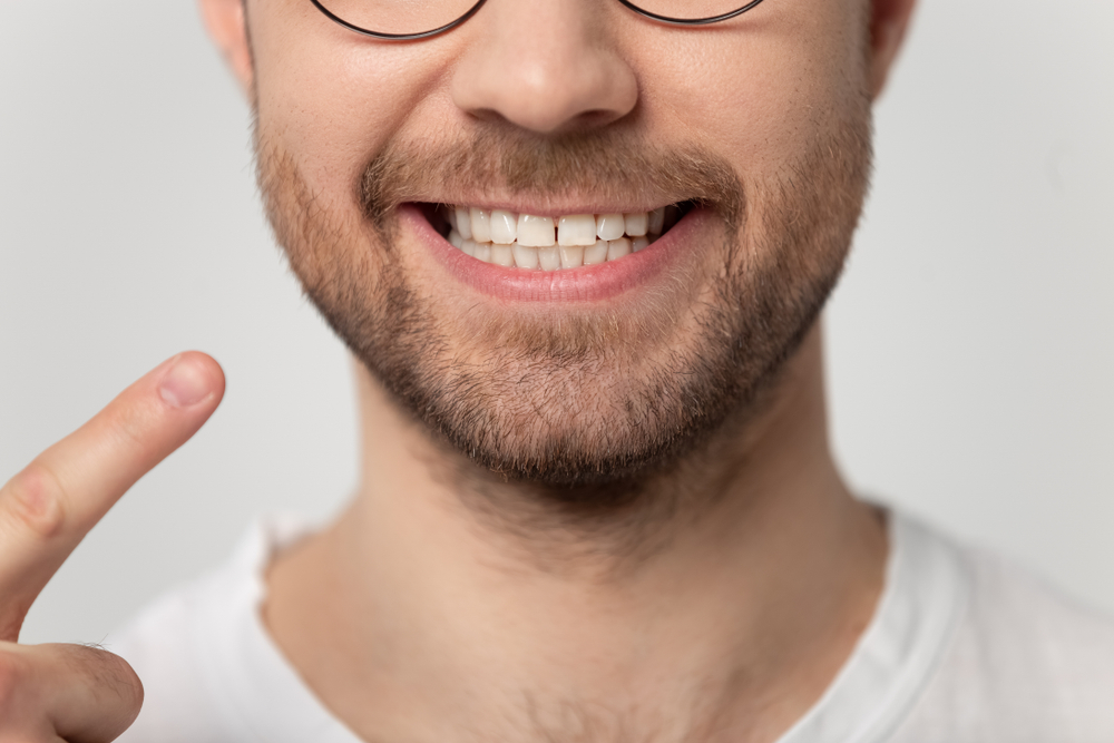young bearded man pointing finger to toothy smile - Dental Implants in Hillcrest